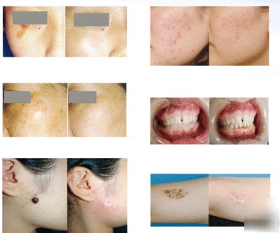 Fractional CO2 laser, medical aesthetic laser, at 20K